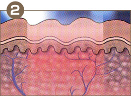 レーザーを照射。痛みは無く、皮膚深部まで熱作用をもたらします。